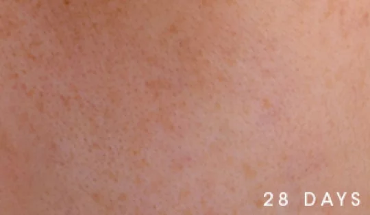 Close-up of skin texture labeled '28 DAYS.'