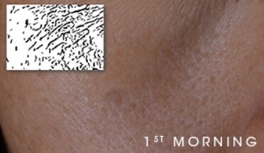 Close-up of skin texture labeled '1st MORNING.'