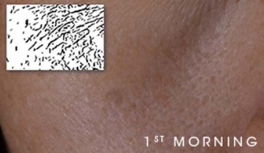 Close-up of skin texture labeled '1st MORNING.'