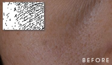 Close-up of skin texture labeled 'BEFORE.'