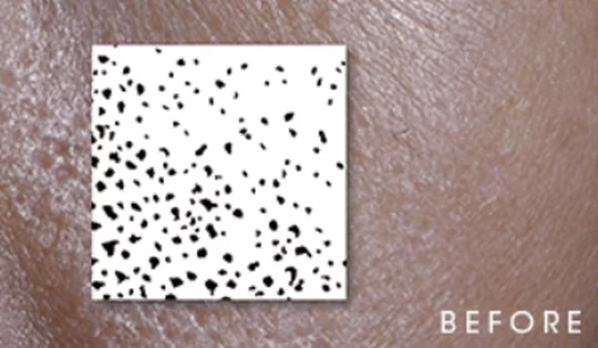 Close-up of skin texture labeled 'BEFORE.'