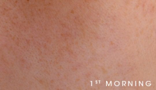 Close-up of skin texture labeled '1st MORNING.'