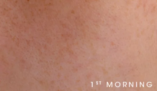 Close-up of skin texture labeled '1st MORNING.'