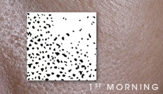 Close-up of skin texture labeled '1st MORNING.'