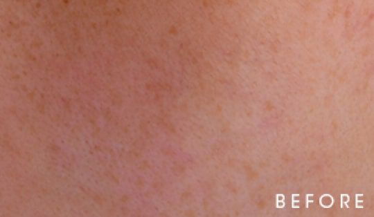 Close-up of skin texture labeled 'BEFORE.'