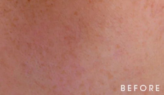 Close-up of skin texture labeled 'BEFORE.'